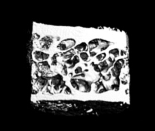 scan of an osteoporosis patient’s bone before treatment