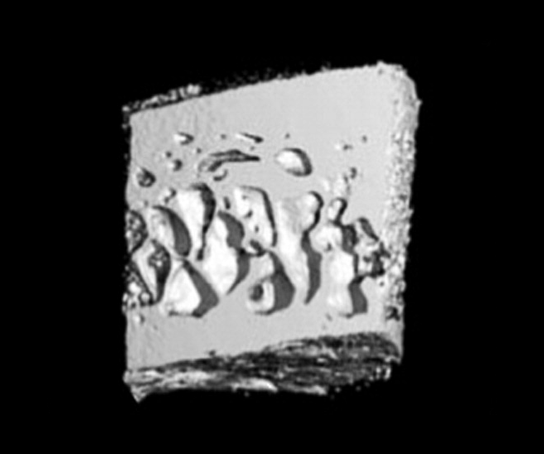 scan of an osteoporosis patient’s bone after treatment